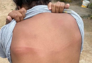 Costas da mulher agredida (Foto: Divulgação) 