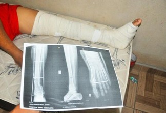 João Ferreira Paiva Júnior sofreu uma fratura na tíbia, na parte inferior da perna (Foto: Wenderson de Jesus/ Folha BV)