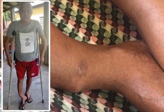Acidente causou danos à perna direita do aposentado (Foto: Divulgação/Montagem)