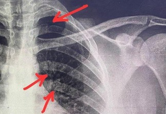 Radiografia mostra fraturas nas costelas do paciente Rafael Morais (Foto: Arquivo Pessoal)