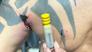 A bala de borracha deixou ferimentos na região da axila, sendo necessário o procedimento de costura na pele (Foto: Camilla Salustiano/FolhaBV)