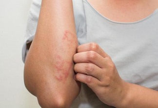 A psoríase se manifesta principalmente por lesões avermelhadas e descamativas na pele (Foto: Divulgação)