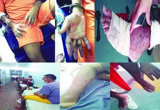 A doença tem atingido vários detentos do maior presídio de Roraima (Fotos:Diane Sampaio/FolhaBV)