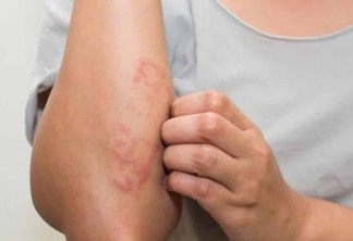 Infectocontagiosa, a hanseníase é causada por uma bactéria e pode provocar, entre os sintomas mais comuns, alterações na pele, como manchas brancas, avermelhadas ou escurecidas (Foto: Divulgação)