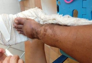 Lourdes Vitória Falcão Braga quebrou a perna e por duas vezes teve a cirurgia cancelada (Foto: Divulgação)