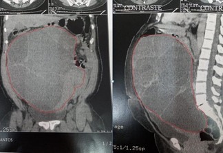 A paciente, precisa retirar o cisto no ovário que está com 5 litros de líquido (Foto: Divulgação)