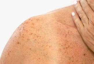 O câncer de pele surge muitas vezes como uma pinta escura ou lesões, que pode coçar ou descamar, ou como uma ferida que não cicatriza. (Foto: Divulgação)