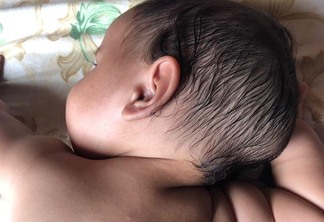 Bebê sofre com doença rara caracterizada pela deformidade da cabeça (Foto: Arquivo pessoal)