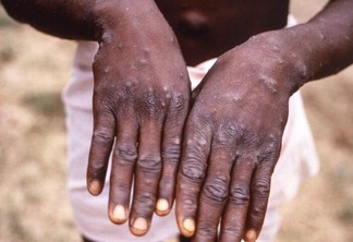 Higienizar as mãos com água e sabão ou álcool gel são importantes ferramentas para evitar a exposição ao vírus (Foto: CDC/Brian W.J Mahy)
