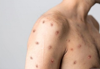 A varíola dos macacos é doença viral, e a transmissão entre humanos ocorre principalmente por meio de contato com lesões de pele de pessoas infectadas (Foto: Reprodução)