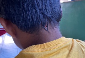 O adolescente teve o rosto atravessado por uma bala que saiu pela nuca (Foto: Hutukara)
