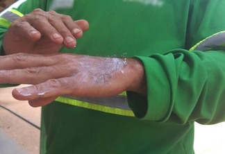 Cerca de 100 pessoas iniciaram tratamento ao câncer de pele, de acordo com Unacon. (Foto: Arquivo FolhaBV)
