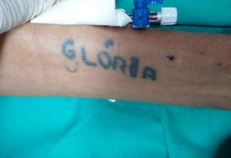 Tatuagem de paciente internado (Foto: Divulgação;/Sesau)