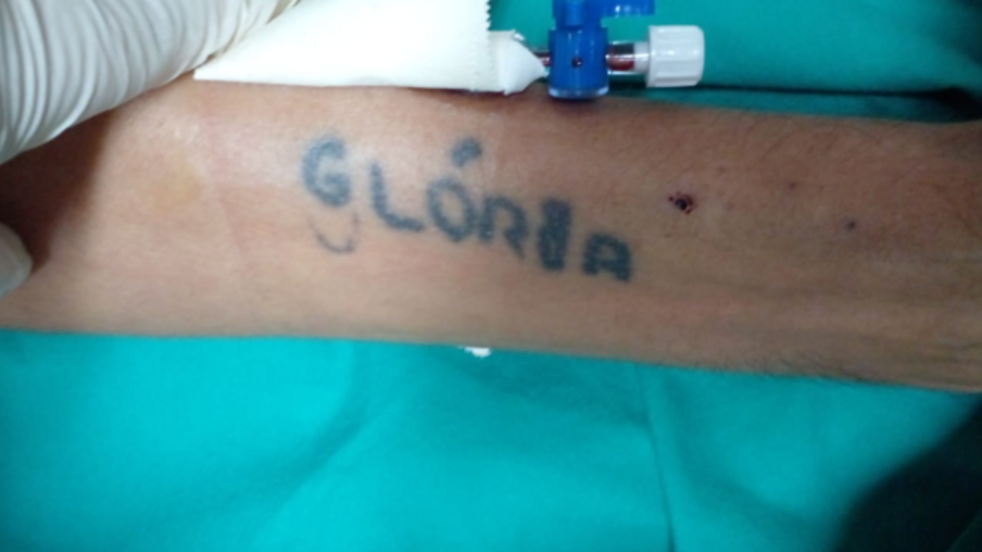 Tatuagem de paciente internado (Foto: Divulgação;/Sesau)
